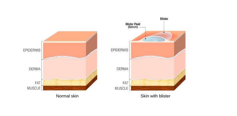 What is Blisterata? Everything You Need to Know About